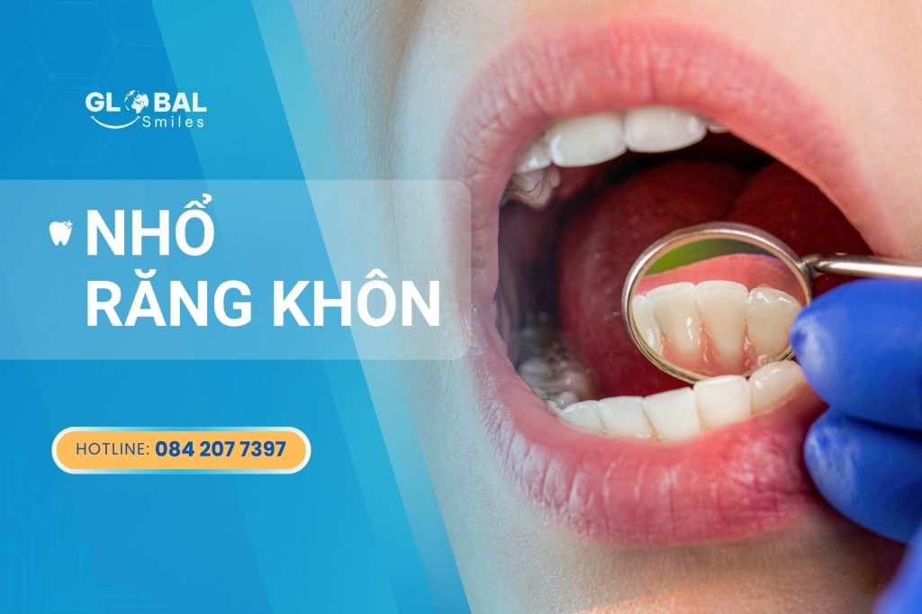 Nhổ răng khôn – Nỗi lo thật sự hay chỉ là “tin đồn”?