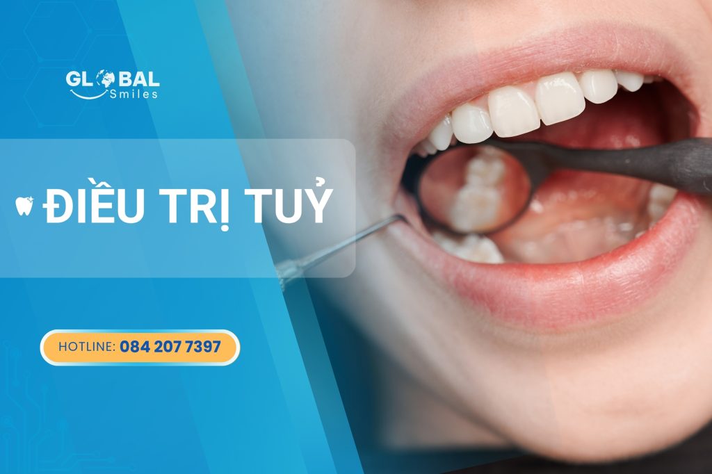 Điều trị tủy – Cách bảo vệ răng thật khi răng đau kéo dài
