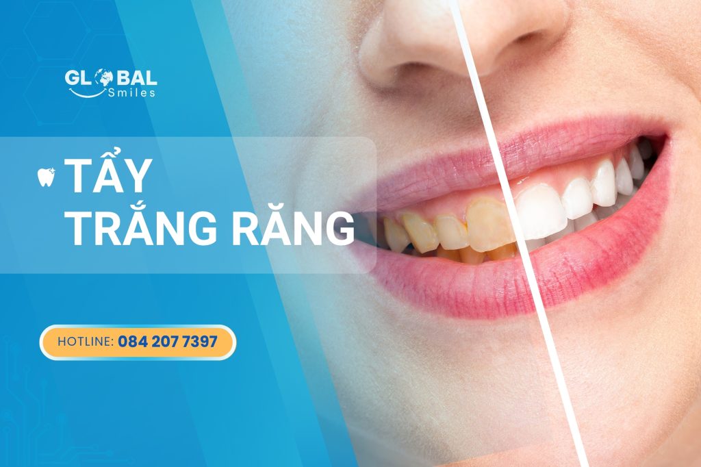 Tẩy trắng răng an toàn, hiệu quả và giữ màu được bao lâu?