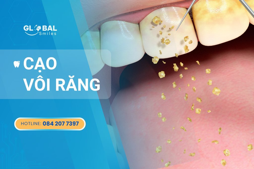 Lý do bạn nên cạo vôi răng định kỳ để bảo vệ răng miệng