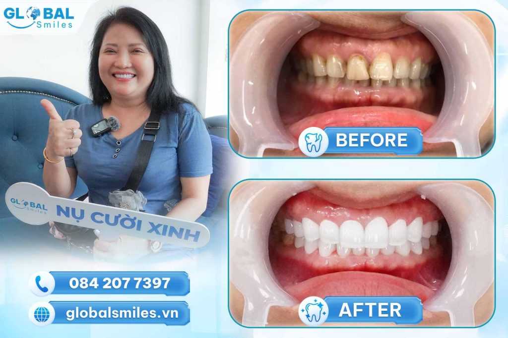 khách hàng bọc răng sứ cercon tại nha khoa Global Smile