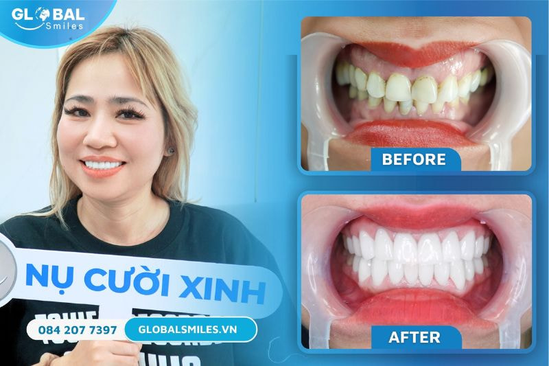 Khách bàng bọc răng sứ tại Nha khoa Global Smile