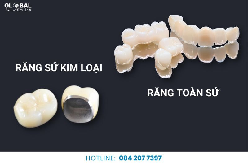 Phân loại các loại răng sứ theo cấu tạo