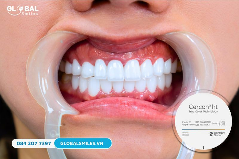 Răng sứ Cercon