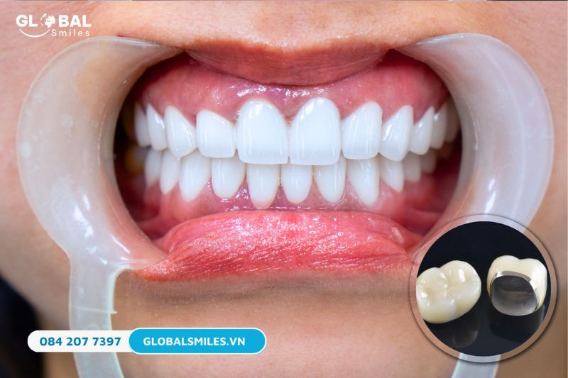 Răng sứ kim loại