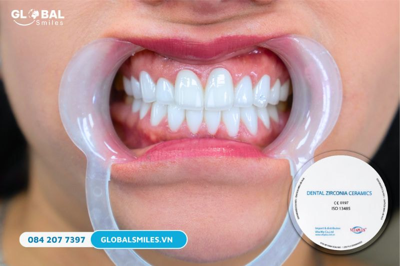 Răng sứ Zirconia