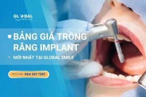 Bảng giá trồng răng Implant