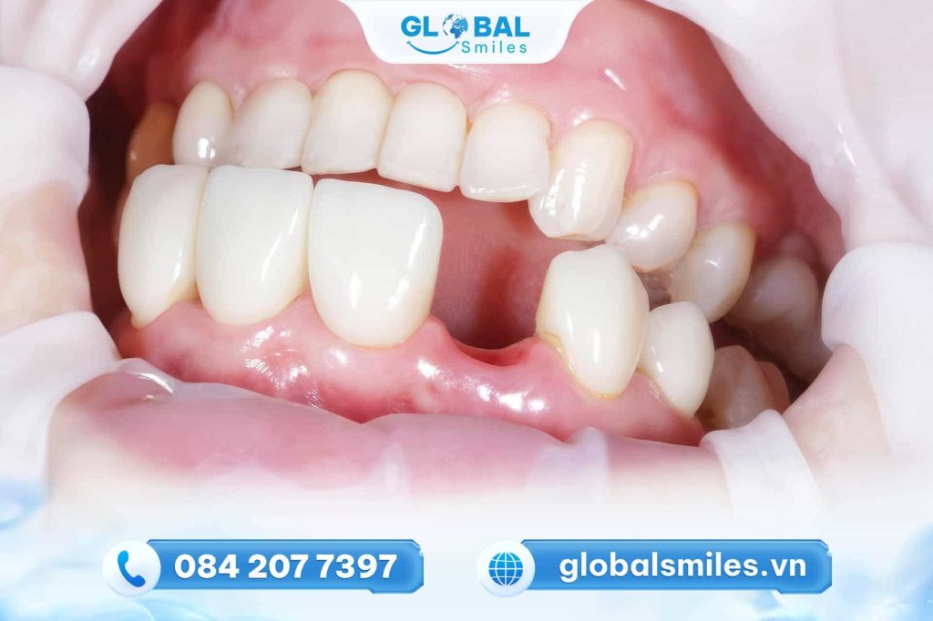 Biến chứng của việc mất răng