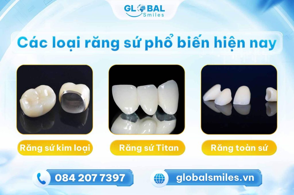 Các loại răng sứ phổ biến hiện nay