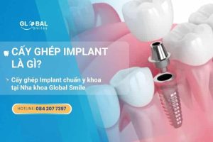 Cấy ghép Implant