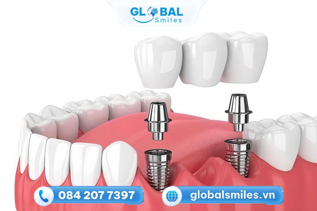 Cấy ghép Implant là gì