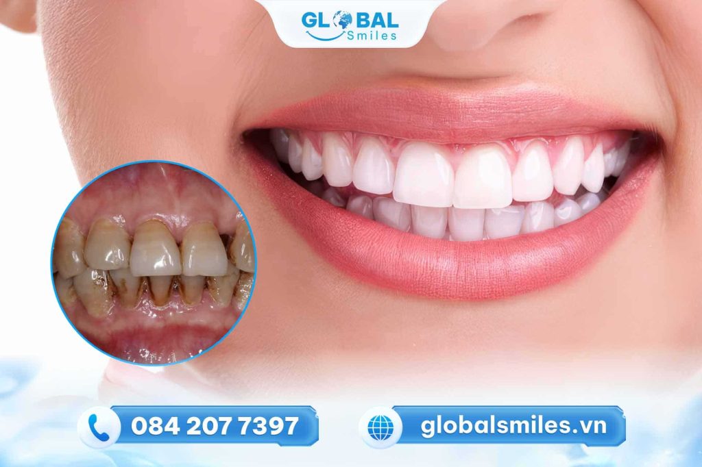 Có nên bọc răng sứ không?