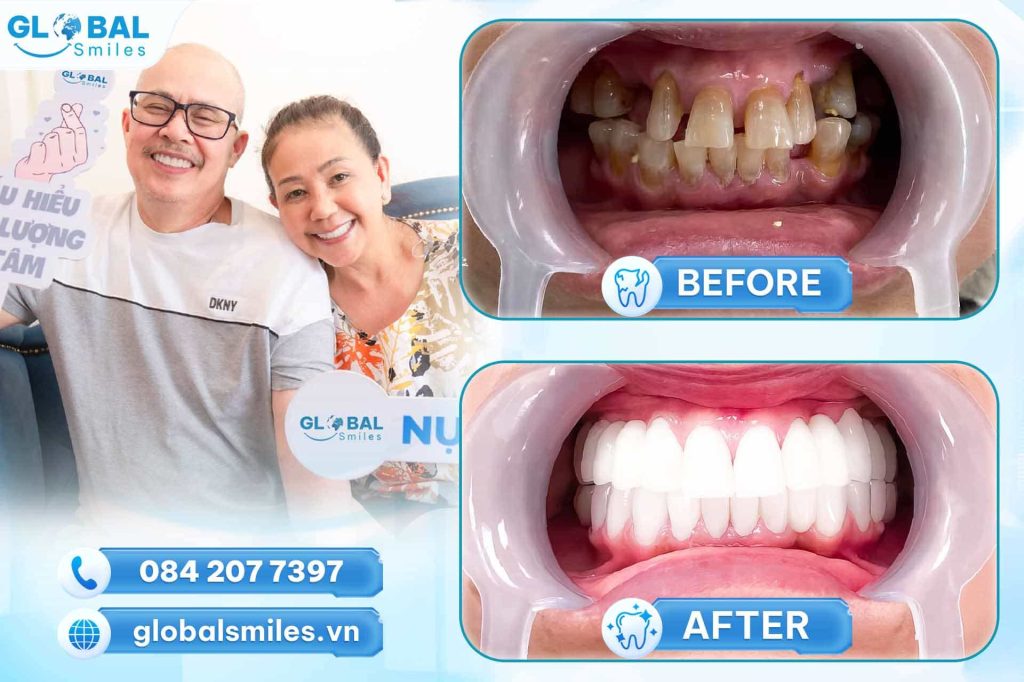 Hình ảnh khách hàng trồng răng Implant tại nha khoa Global Smile