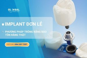 Implant đơn lẻ