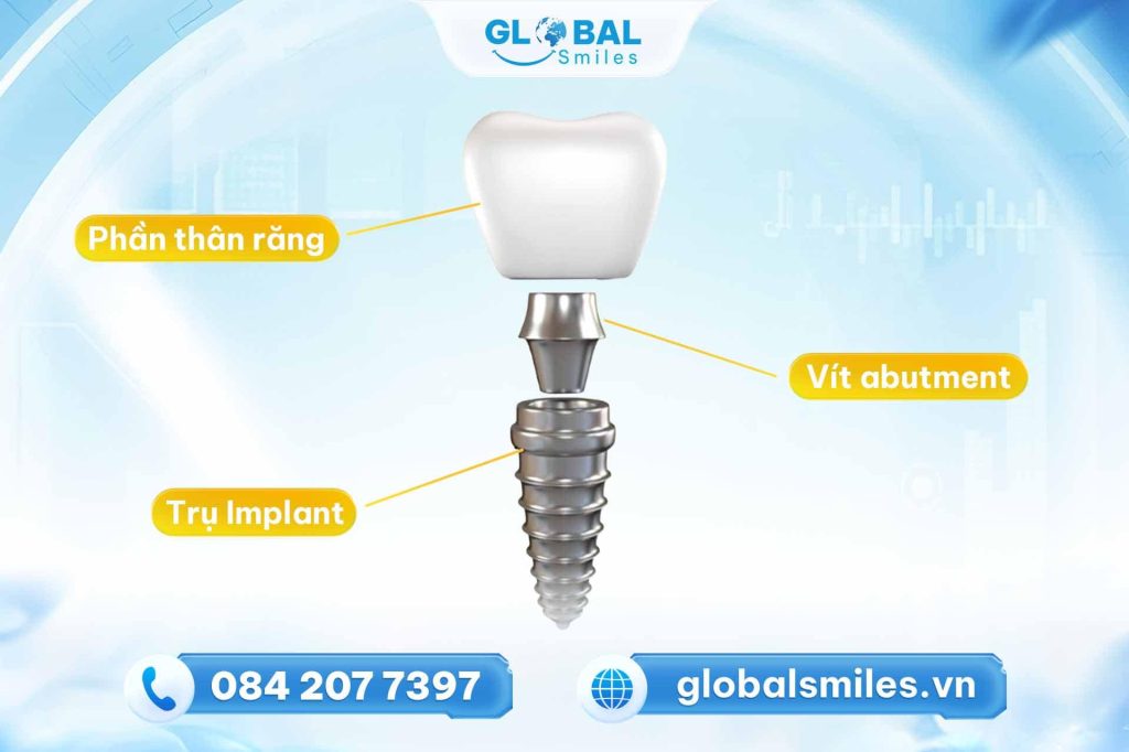 Implant đơn lẻ là gì?