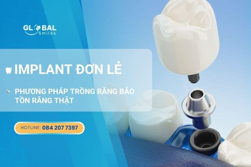 Implant đơn lẻ - Phương pháp trồng răng bảo tồn răng thật