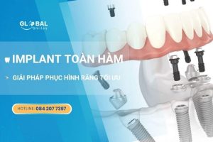 Implant toàn hàm