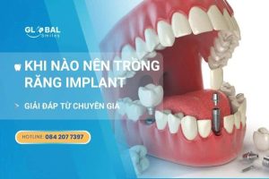 Khi nào thì trồng răng Implant? Giải đáp từ chuyên gia
