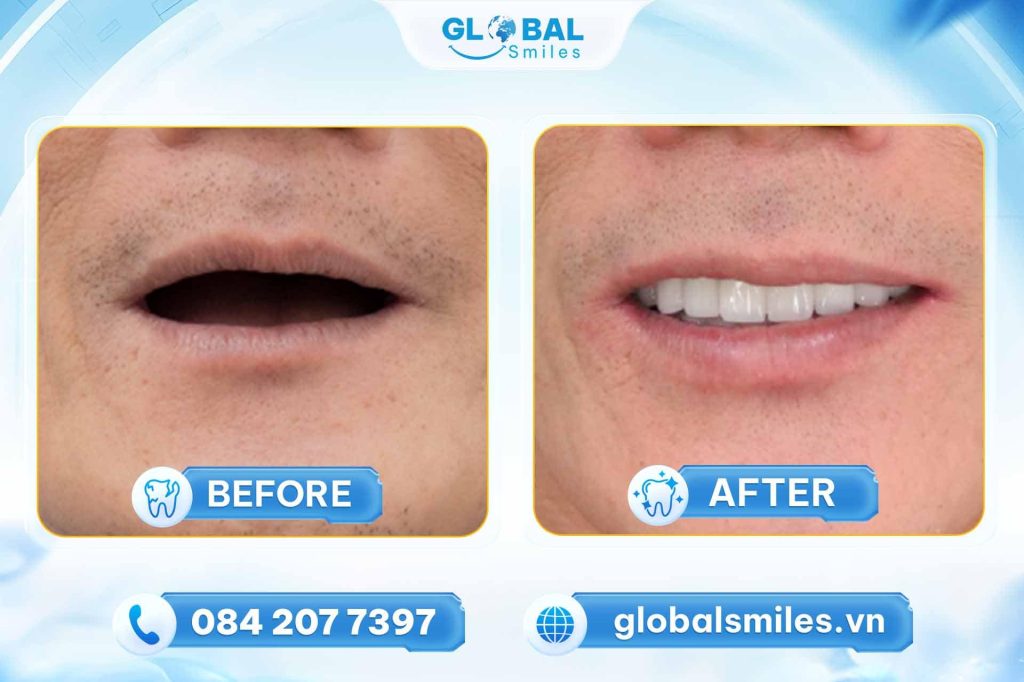 Những ai nên trồng răng Implant toàn hàm