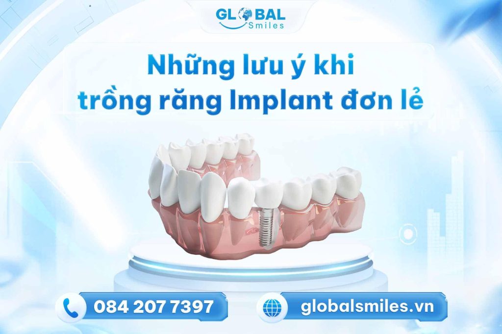 Những lưu ý khi trồng răng Implant đơn lẻ