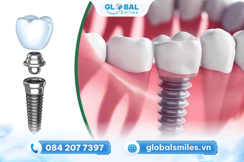 Những trường hợp nào nên trồng răng Implant
