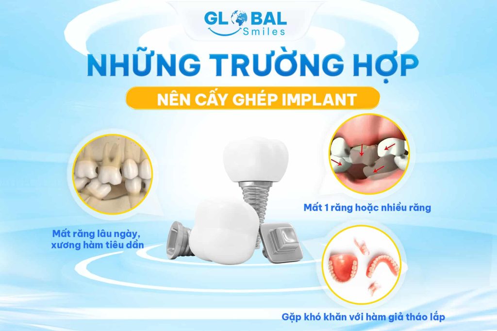 Những trường hợp nên cấy ghép Implant