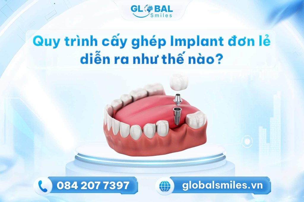 Quy trình cấy ghép Implant diễn ra như thế nào?