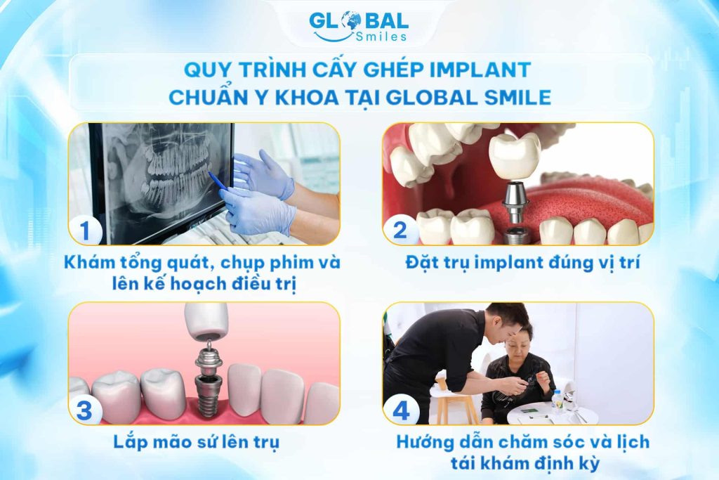 Quy trình cấy ghép Implant chuẩn y khoa tại Nha khoa Global Smile