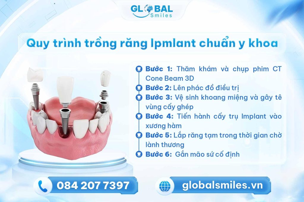 Quy trình trồng răng Implant chuẩn y khoa