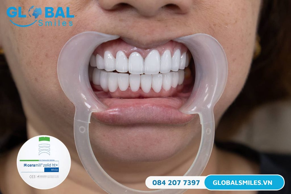Răng sứ Ceramill Zolid