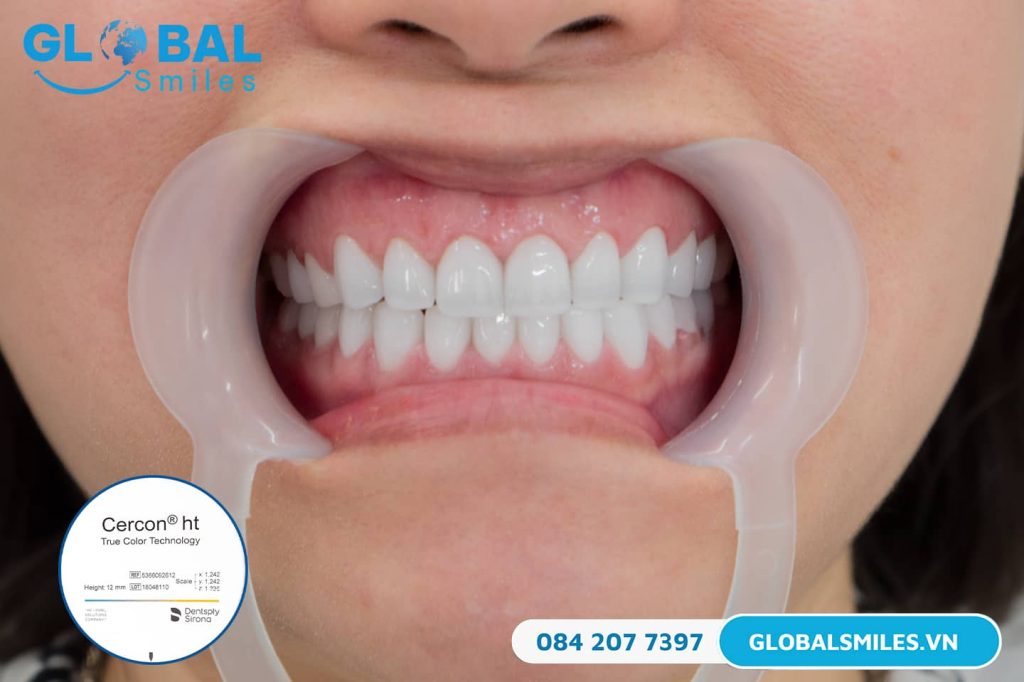 Răng sứ Cercon HT