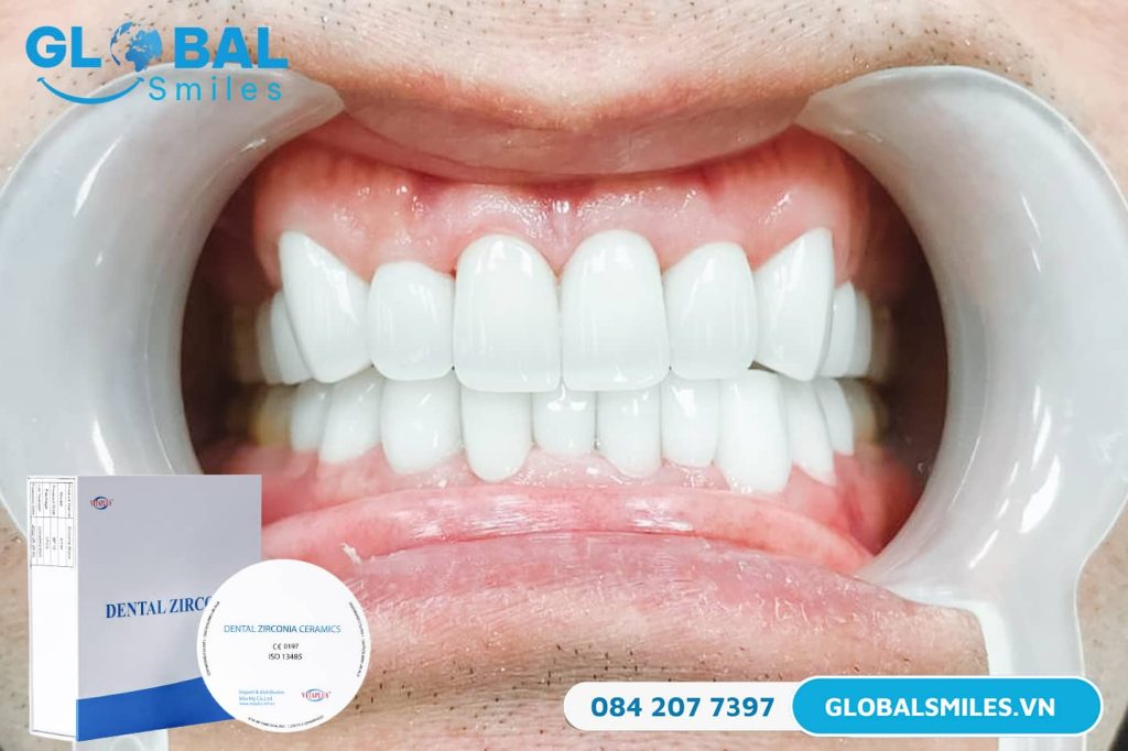 Răng sứ Zirconia