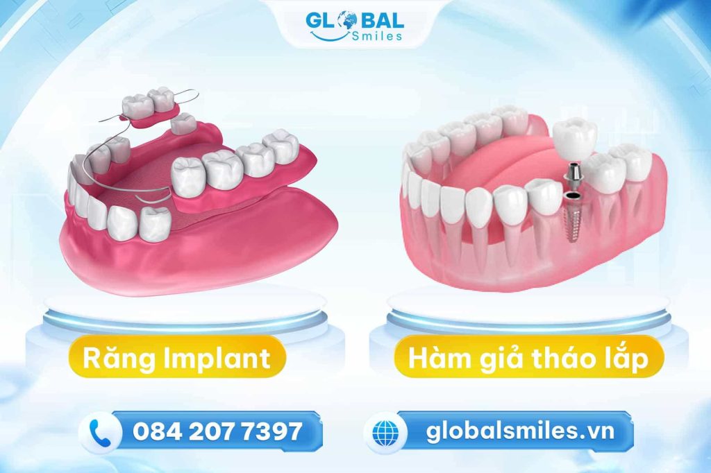 Sự khác nhau giữa trồng răng Implant và hàm giả tháo lắp