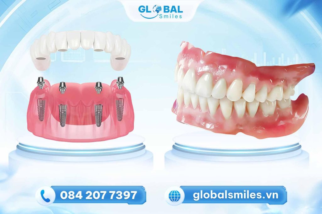 Sự khác nhau giữa hàm giả tháo lắp và trồng răng Implant