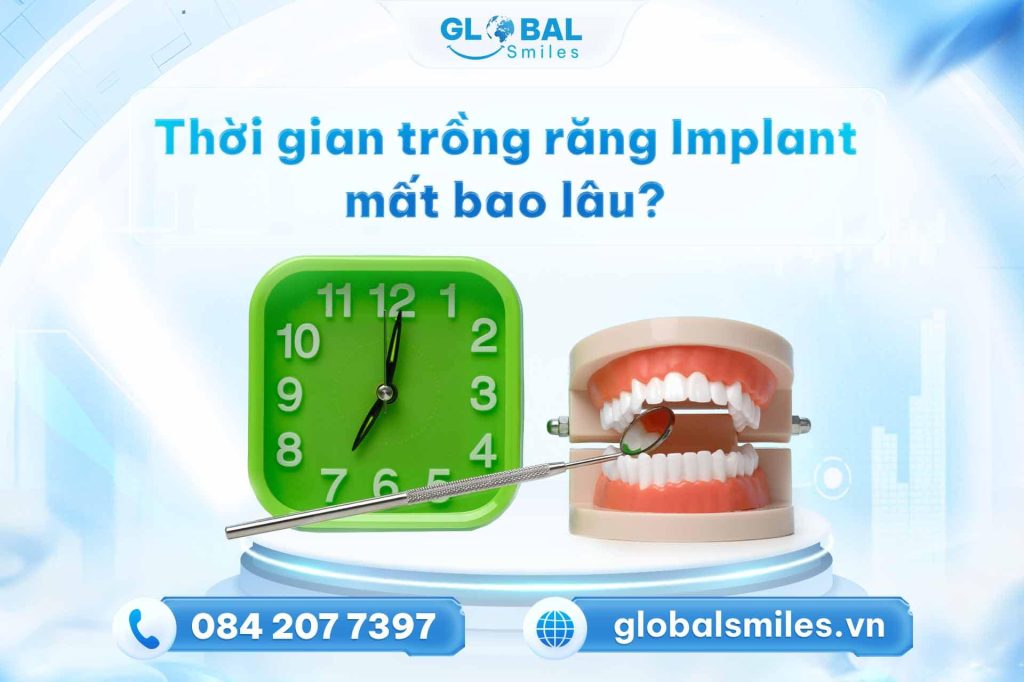 Thời gian trồng răng Implant giao động từ 2 - 6 tháng