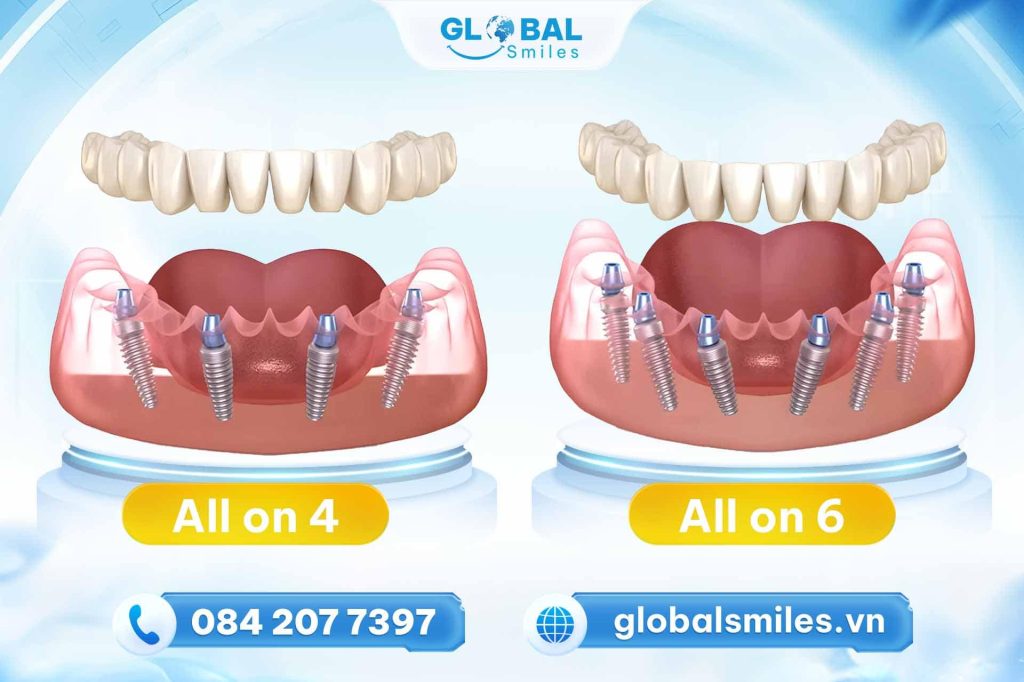 Trồng răng Implant All on 4 và All on 6