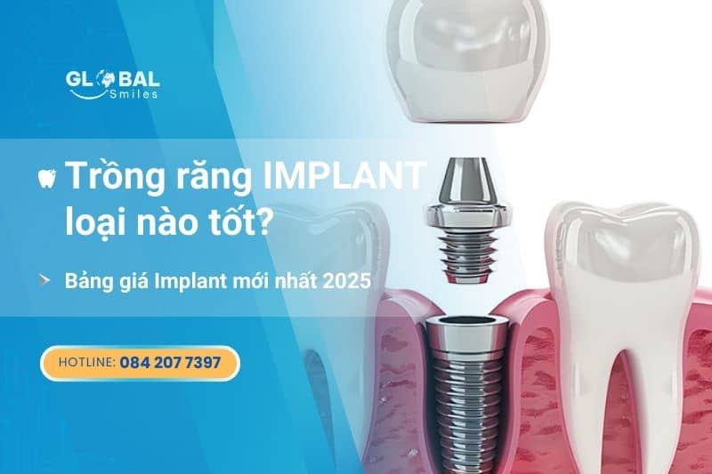 Trồng răng Implant loại nào tốt? Giá Implant mới nhất 2025