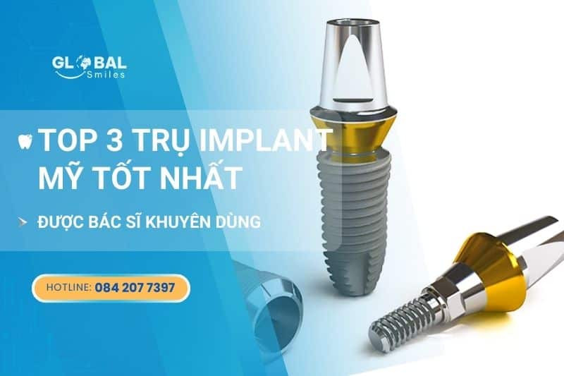 Top 3 trụ Implant Mỹ tốt nhất được bác sĩ khuyên dùng