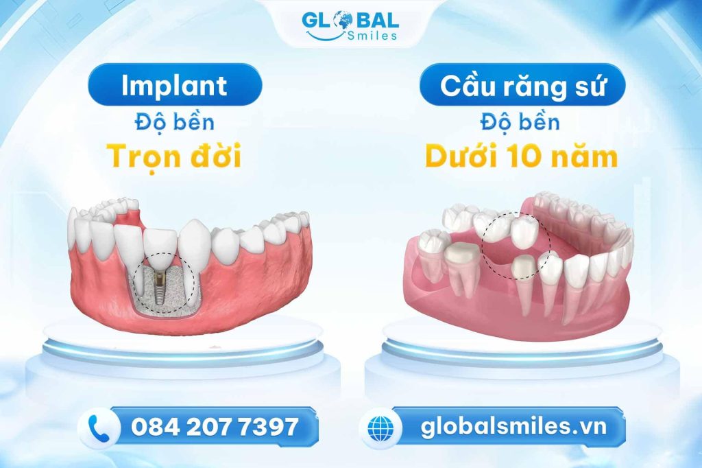 Ưu nhược điểm của trồng răng Implant và cầu răng sứ