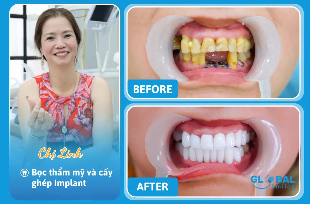 Chị Linh Nha Khoa Global Smiles