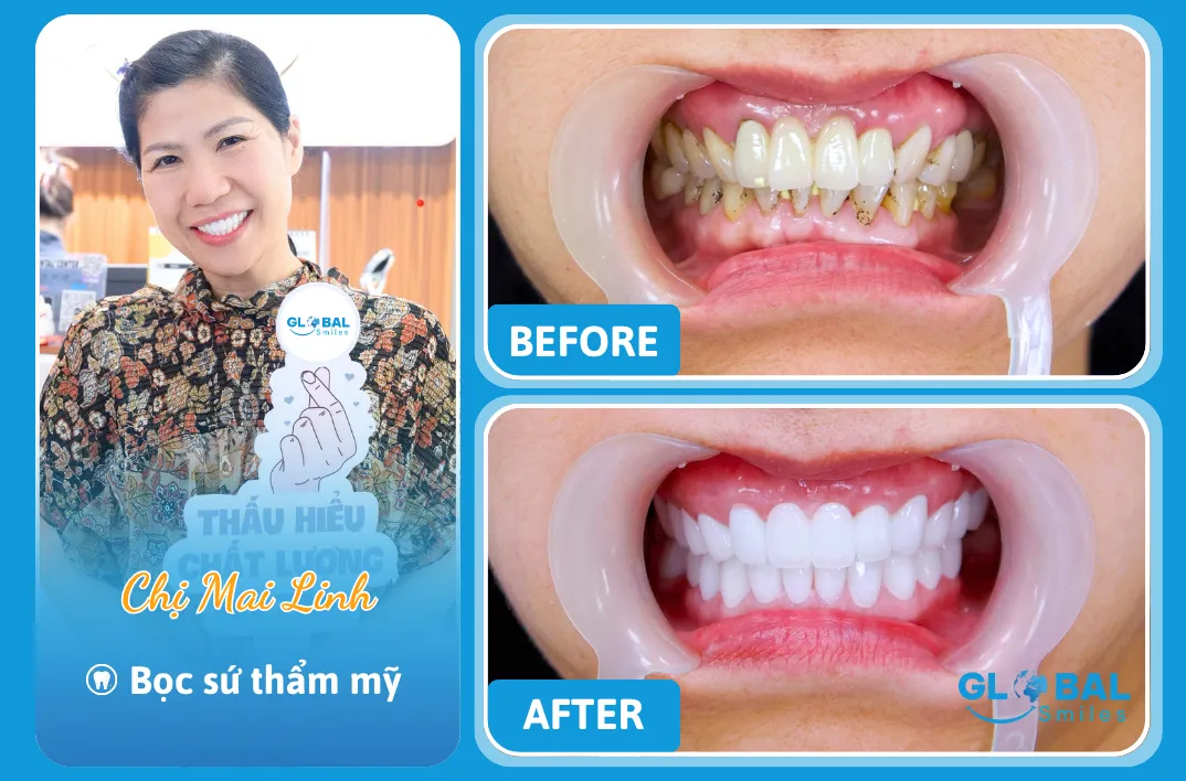 Chị M.Linh Nha Khoa Global Smiles