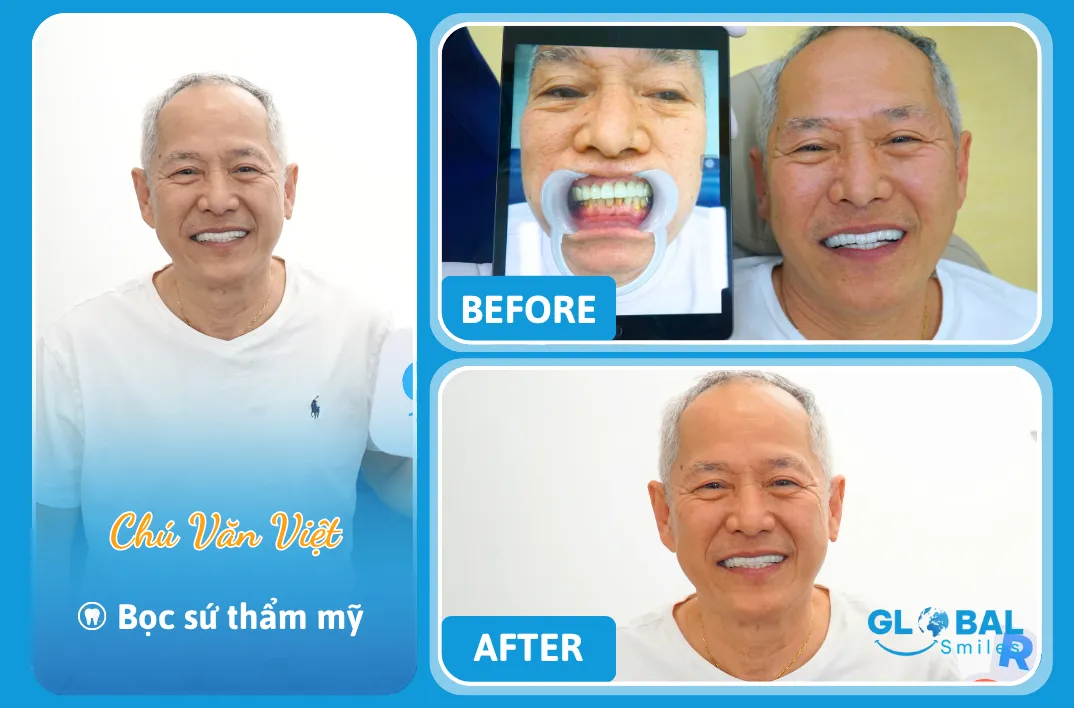 Chú Việt Nha Khoa Global Smiles