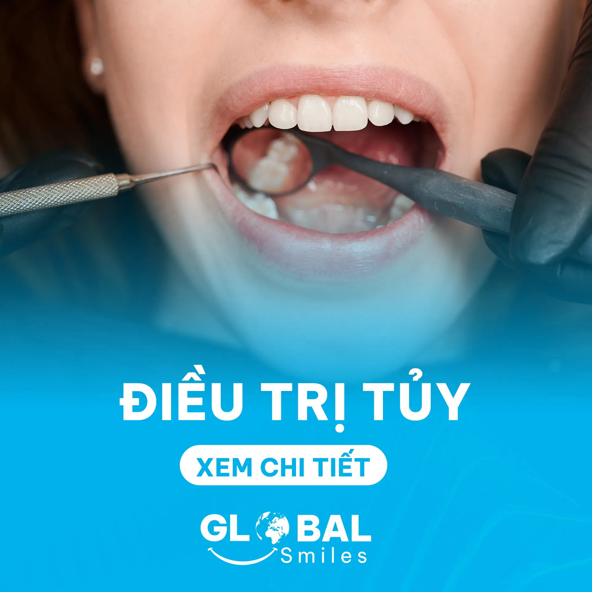 Dieu-tri-tuy_Nha Khoa Global Smiles