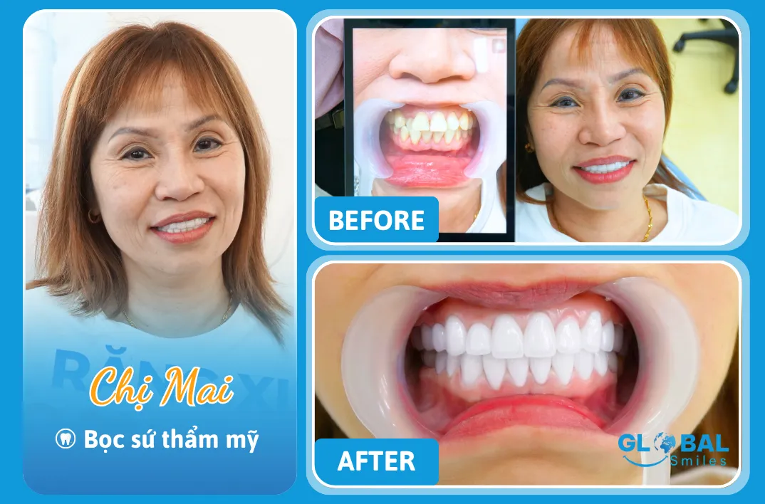 KH Chị mai Nha Khoa Global Smiles