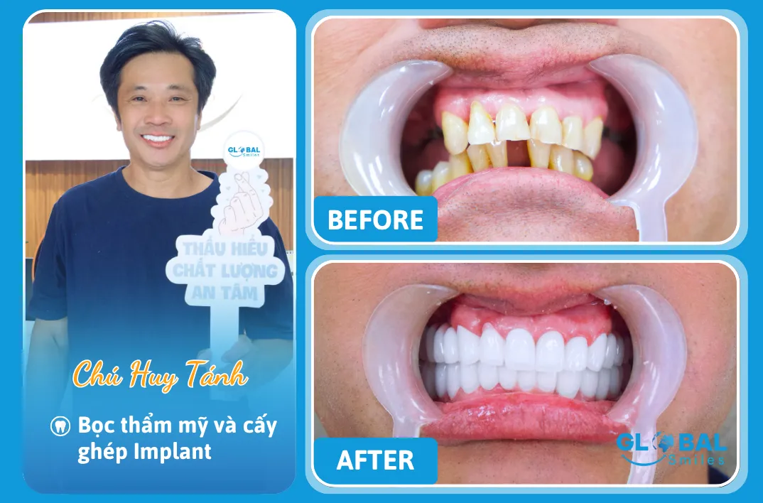 KH Huy Tánh Nha Khoa Global Smiles