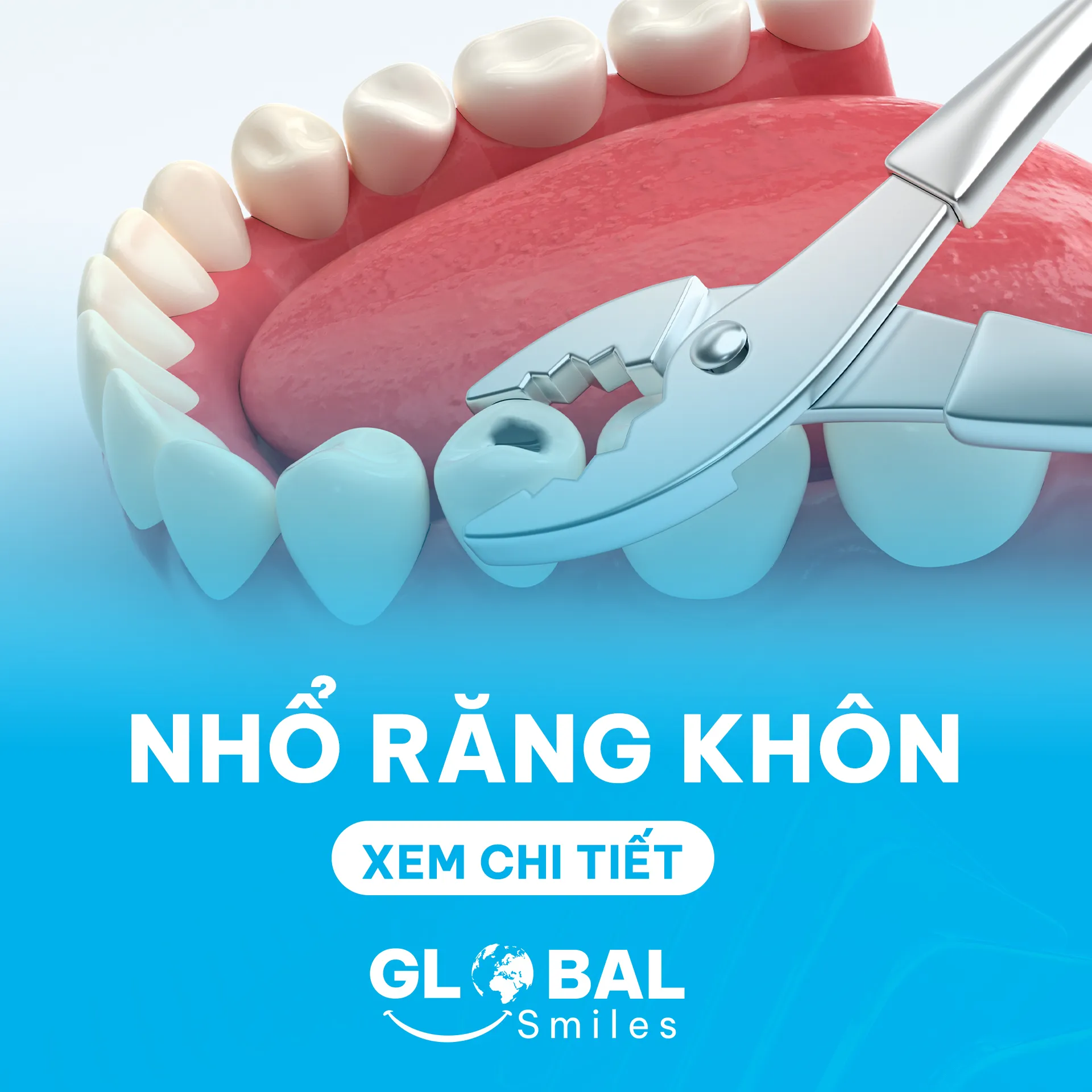 Nho-rang-khonNha Khoa Global Smiles