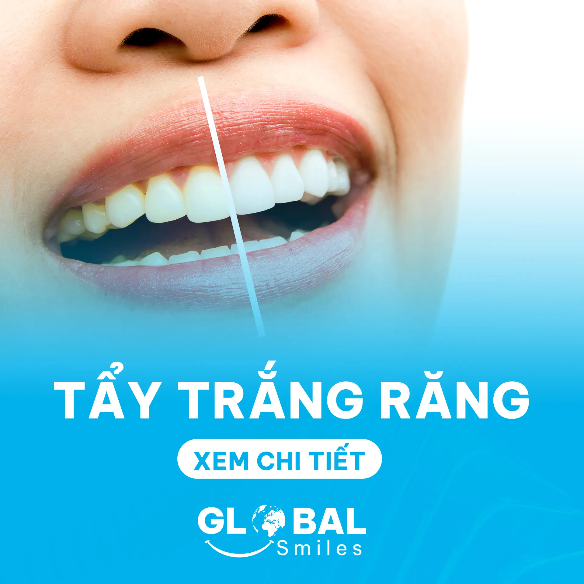 Tay-trang-rang-Nha Khoa Global Smiles