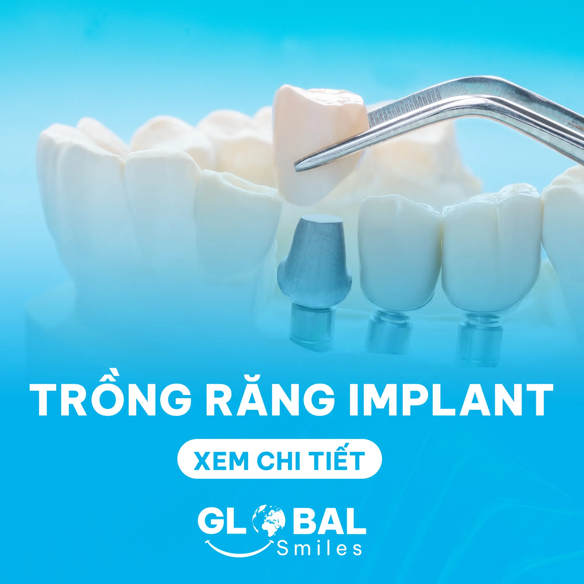 Trong-rang-Implant-Nha Khoa Global Smiles